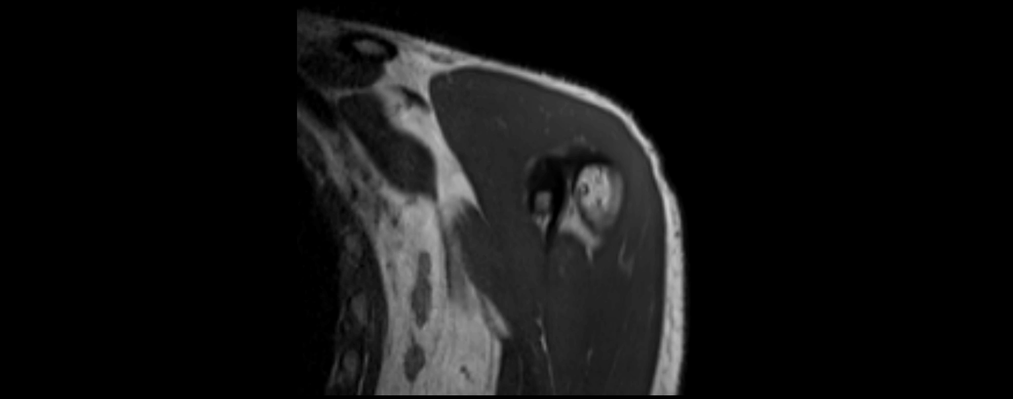 shoulder ligments coronal  cross sectional anatomy 3T MRI AI enhanced radiology image -img-00001-00004.webp